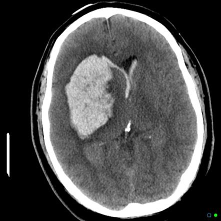 Brain CT: 우측 중대뇌동맥 영역의 광범위한 뇌경색 부위 내에 발생한 고음영의 급성 뇌출혈 소견