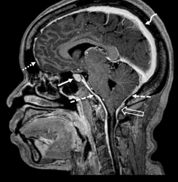 뇌 MRI Coronal T1CE 영상. 미만성 경막조영증강(diffuse pachymeningeal enhancement)이 관찰됨.