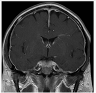 뇌 MRI Sagittal T1CE 영상. 뇌하수체 비대(pituitary enlargement)와 뇌하강(brain sagging) 소견이 관찰됨.